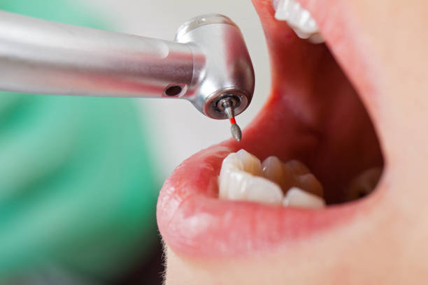 Best Emergency Root Canal Treatment in Almedia, PA